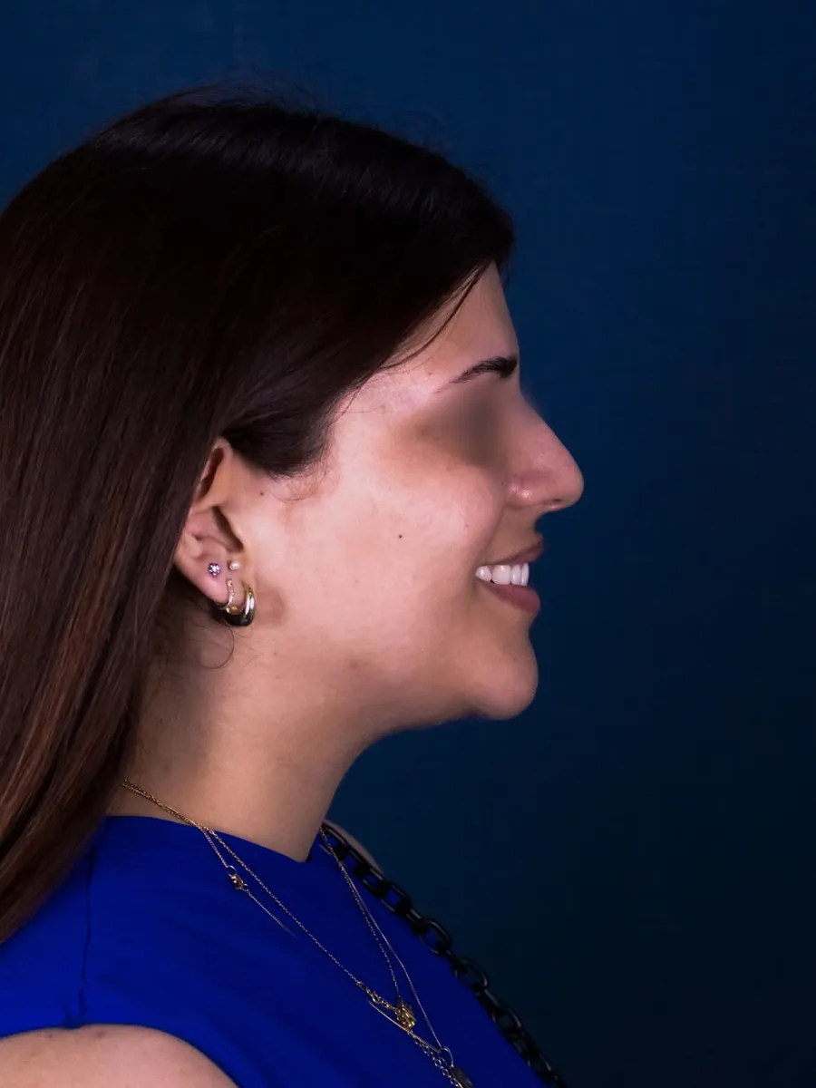 Rinoplastia, caso 3, Dr. Manuel Jara, Lima antes