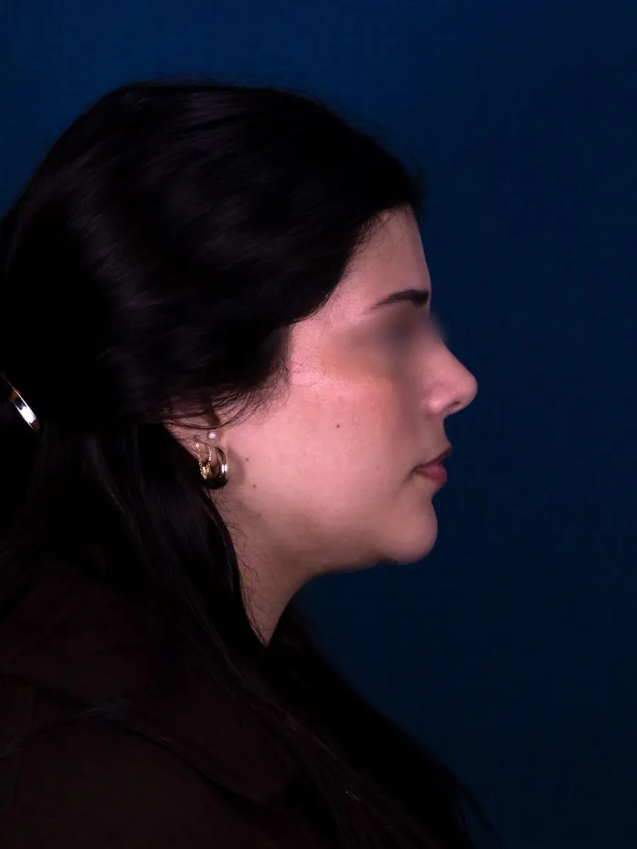 Rinoplastia, caso 3, Dr. Manuel Jara, Lima después