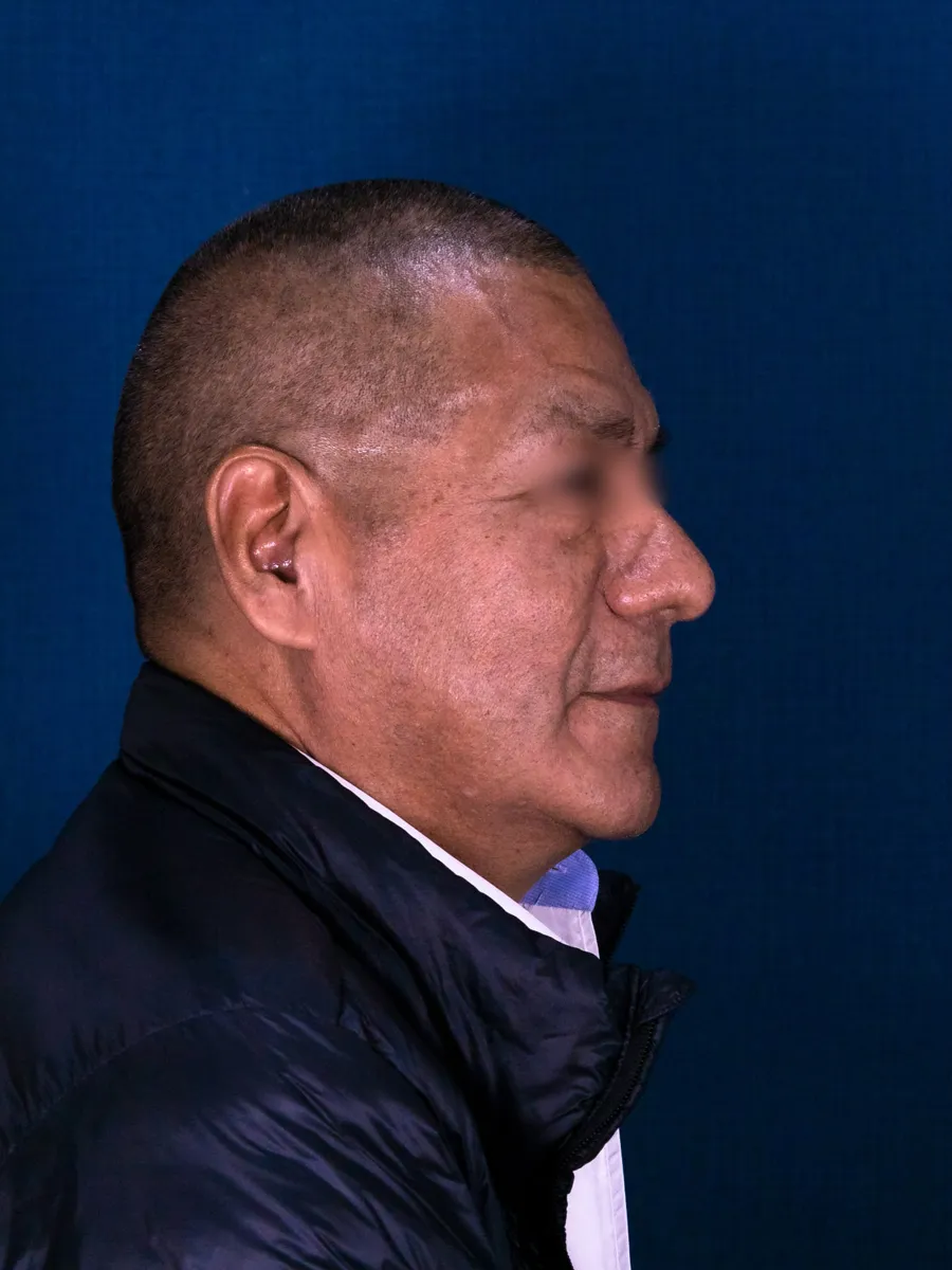 Rinoplastia, caso 5, Dr. Manuel Jara, Lima antes