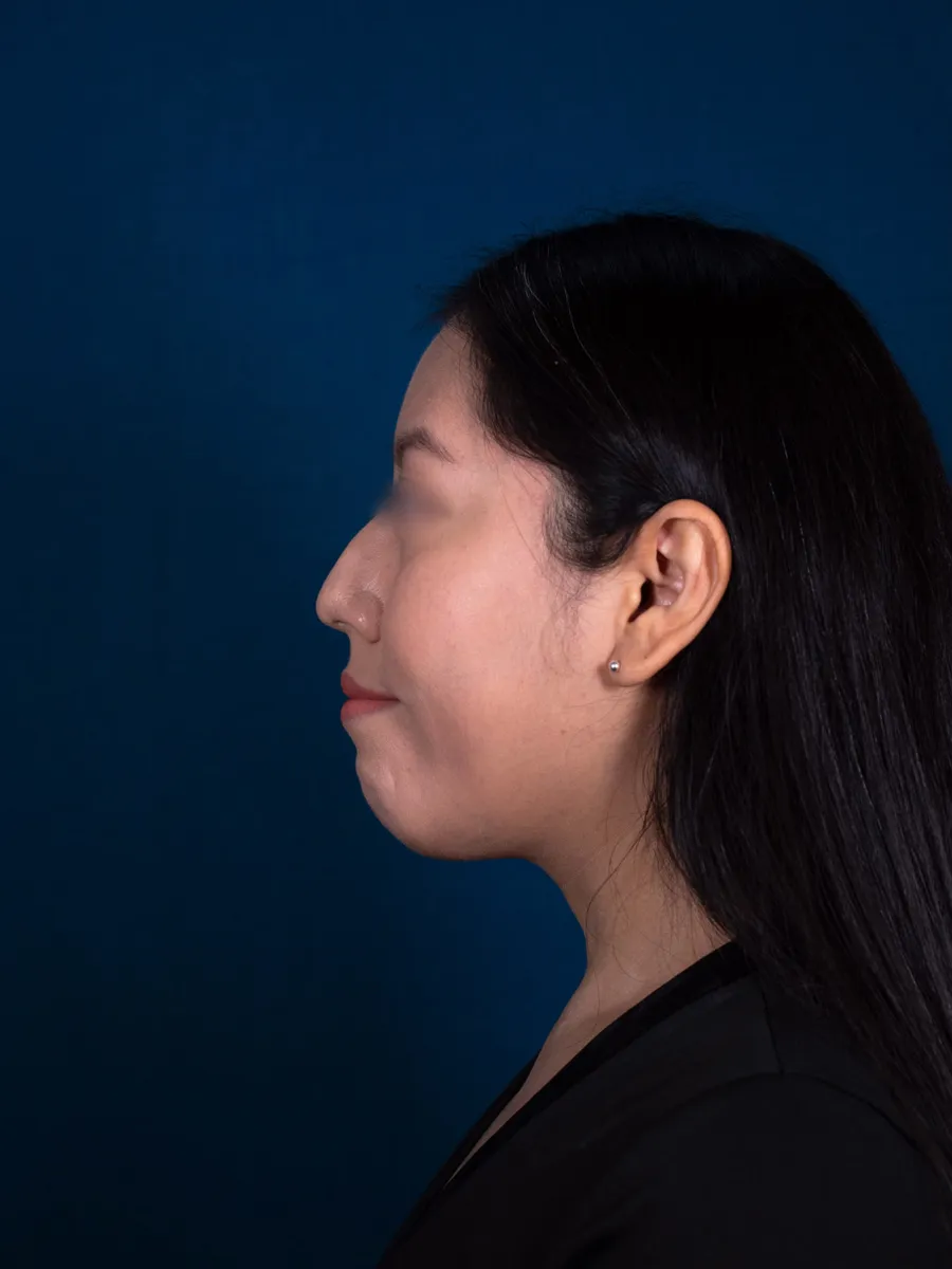 Rinoplastia, caso 2, Dr. Manuel Jara, Lima antes