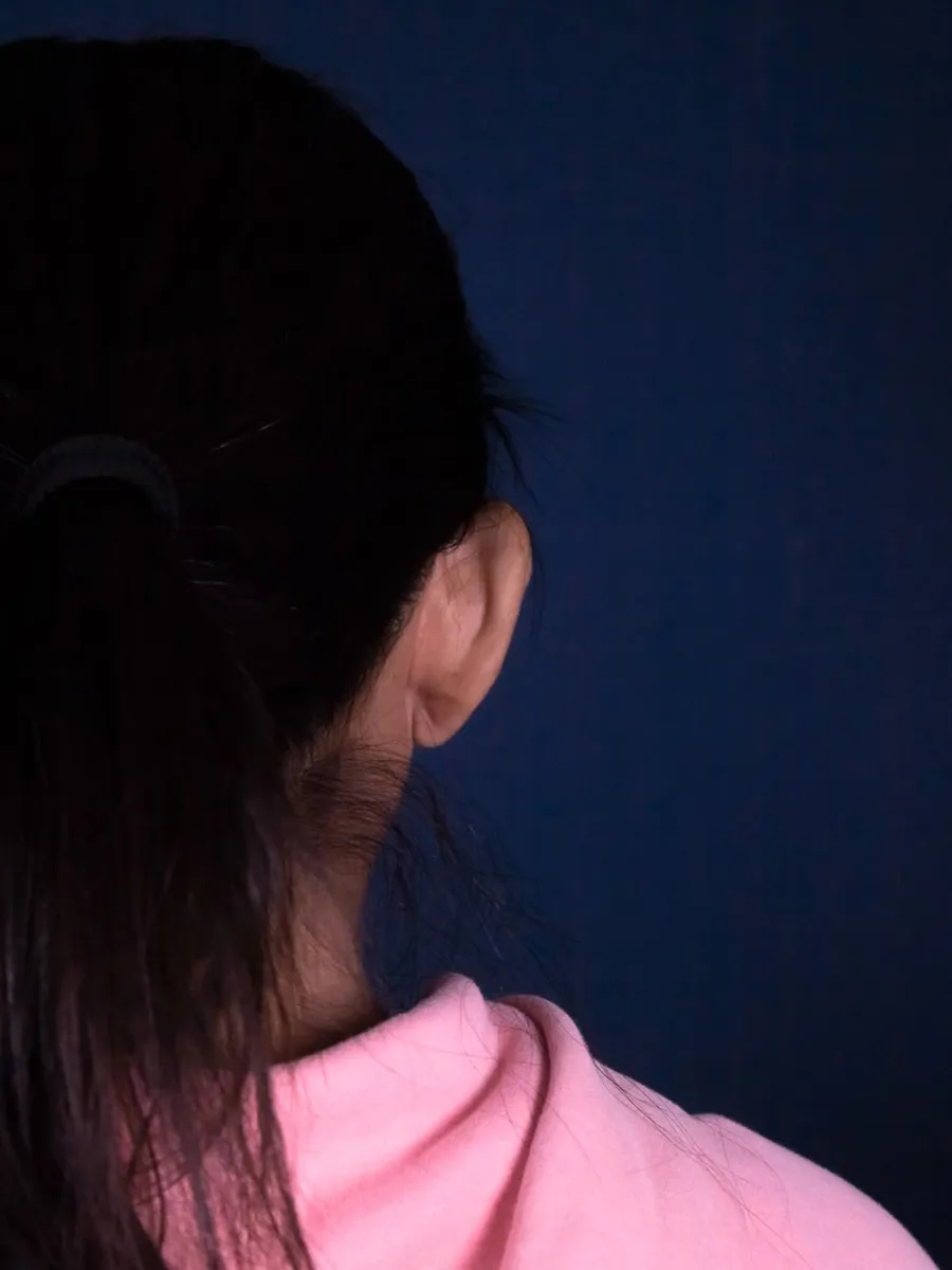 Otoplastia, caso 2, Dr. Manuel Jara, Lima después