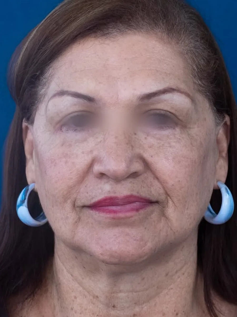 Blefaroplastia, caso 1, Dr. Manuel Jara, Lima antes