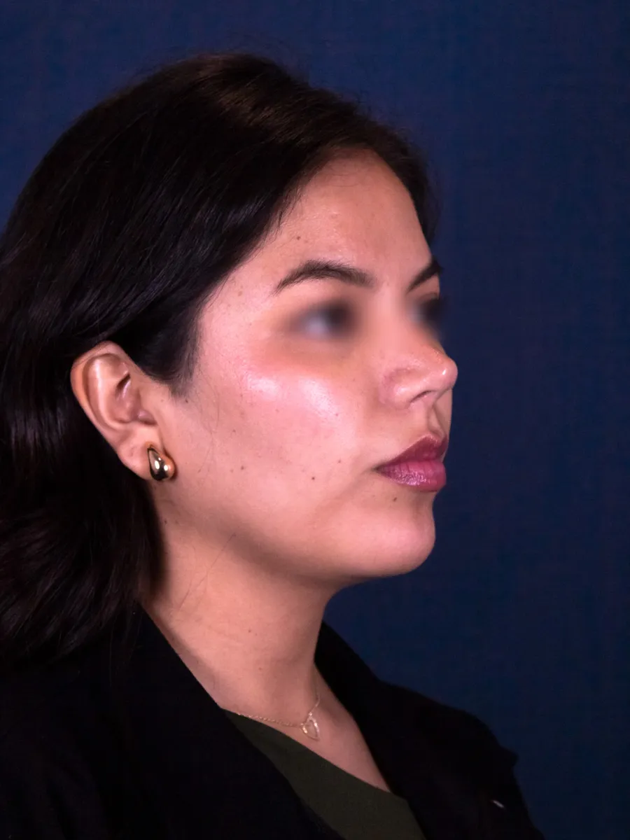 Rinoplastia, caso 1, Dr. Manuel Jara, Lima después
