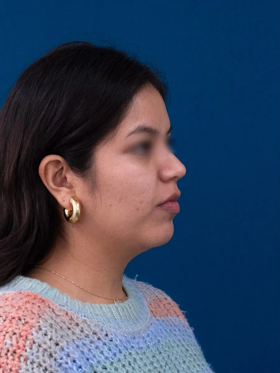 Rinoplastia, caso 1, Dr. Manuel Jara, Lima antes