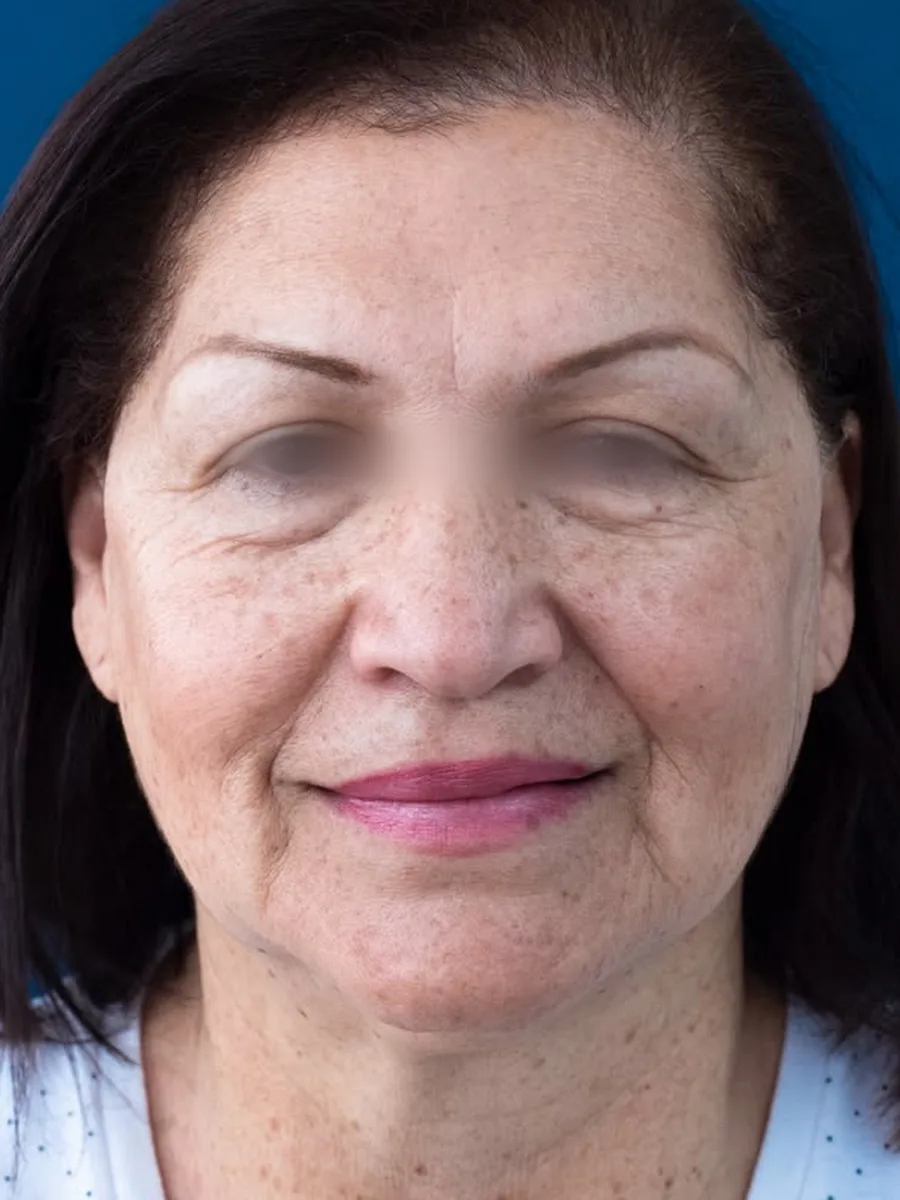 Blefaroplastia, caso 1, Dr. Manuel Jara, Lima después
