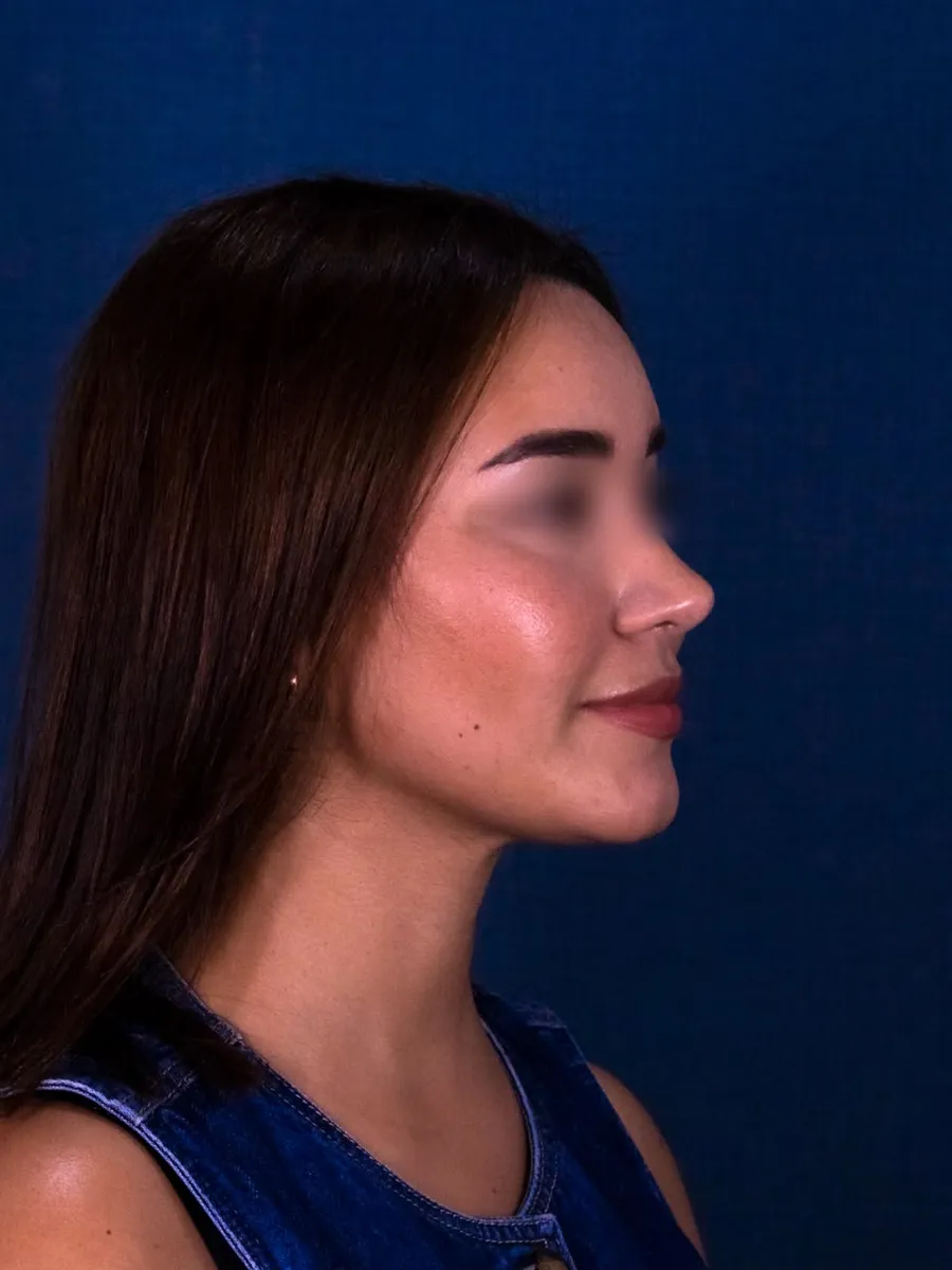 Rinoplastia, caso 4, Dr. Manuel Jara, Lima después