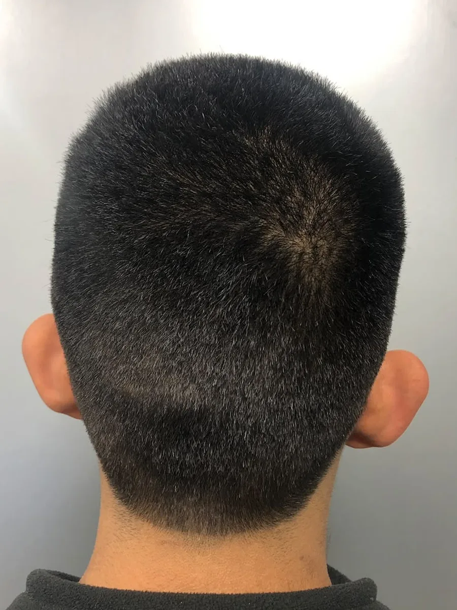Otoplastia, caso 1, Dr. Manuel Jara, Lima antes