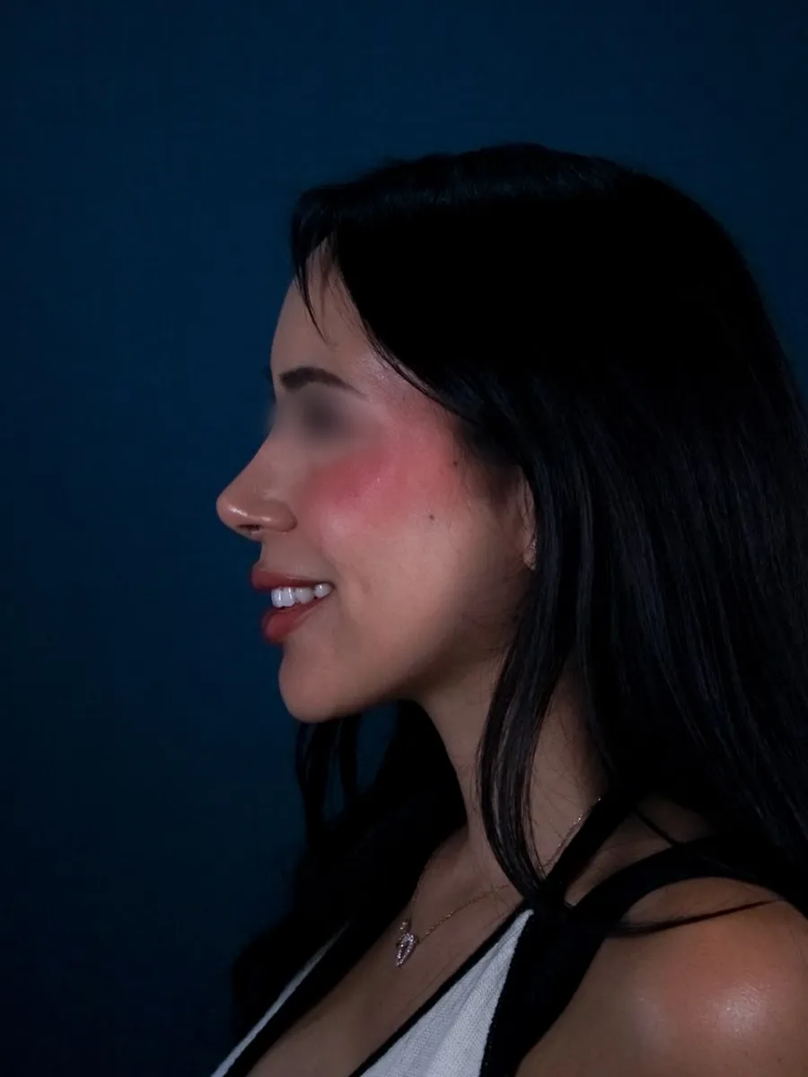 Rinoplastia, caso 6, Dr. Manuel Jara, Lima después