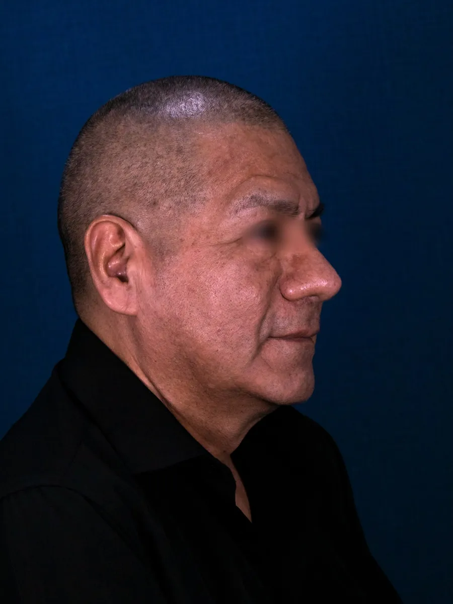Rinoplastia, caso 5, Dr. Manuel Jara, Lima después